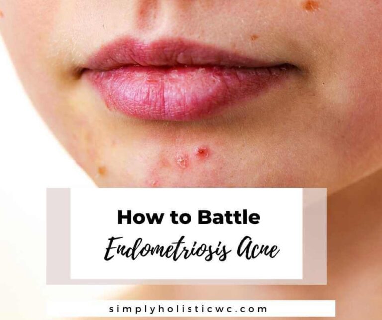 How to Battle Endometriosis Acne Naturally