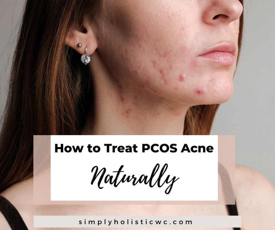 PCOS acne